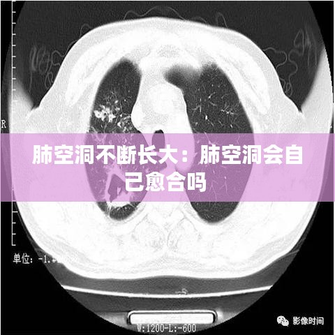 肺空洞不断长大：肺空洞会自己愈合吗 