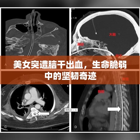 美女突遭脑干出血，生命脆弱中的坚韧奇迹